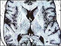 Epilepsy triggers seizures in the brain
