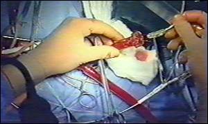 Re-blocking after heart procedures is frequent