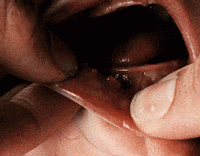 Daily pill may prevent genital-herpes infection 