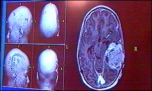 Some tumours are hard to remove by surgery