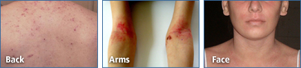 Eczema examples on the back, arms, and face.