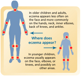 Where does eczema appear? In older children and adults, eczema appears less often on the face and more commonly on the hands, neck, inner elbows, back of knees, and ankles. In younger children, eczema usually appears on the face, elbows, or knees, and possibly on other areas.