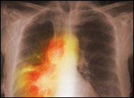 Cancer: Overview, Causes, Risk Factors, Treatment