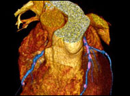 Hypertension- High Blood Pressure