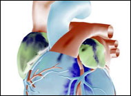 Hypertension- High Blood Pressure