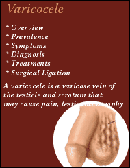 Varicocele - Non-surgical Treatment for Male Infertility