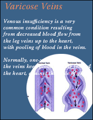 Venous insufficiency is a very common condition resulting from decreased blood flow from the leg veins up to the heart, with pooling of blood in the veins