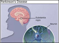 Gene Therapy Treatment to Combat Parkinsons Disease