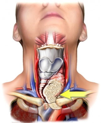 Thyroid Cancer Treatment Varies by Hospital 