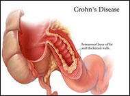 Crohn's disease ups risk of intestinal cancer