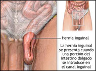 Delaying Surgery Safe Acceptable Option for Some Men with Hernia
