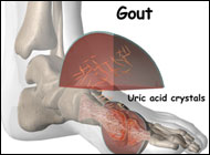 Diuretic use implicated in Gout attacks