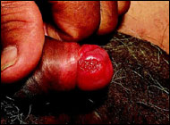 Small, relatively unremarkable ulcerative lesion of squamous cell carcinoma of glans penis