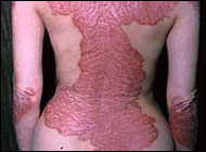 Psoriasis tied to depression, suicide