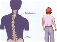 Scientists identify first gene linked to scoliosis