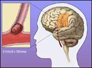 Moderate to Severe Sleep-Disordered Breathing Can Lead to Stroke