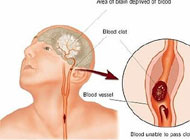 Quarter of stroke patients die within a year