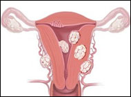 New Clinical Trial to Examine Ways to Improve Treatment of Uterine Fibroids