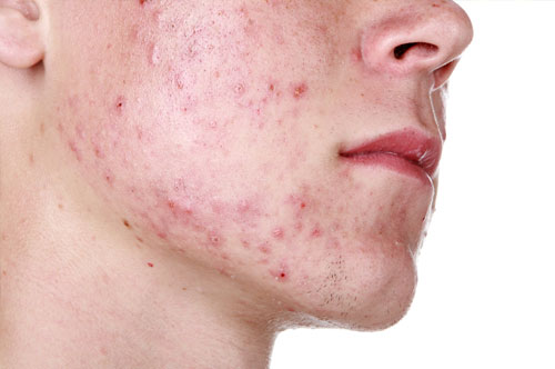 After pills, gels keep acne at bay