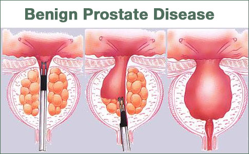 benign prostatic hyperplasia introduction)
