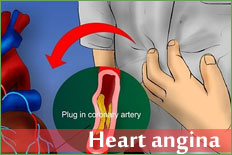 FAQ About Heart Attack