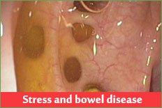 Stress may be a trigger of bowel disease symptoms