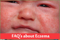 FAQ's about Eczema (Atopic Dermatitis)