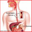 Esophageal Cancer