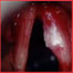 Laryngeal Cancer