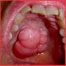 Cancer of the Oropharynx