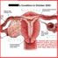 Uterine Cancer