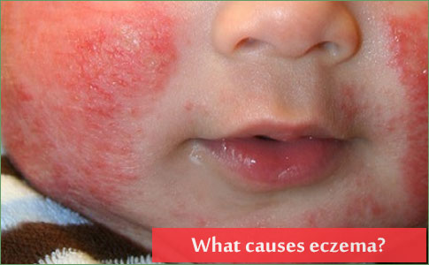 What causes eczema?
