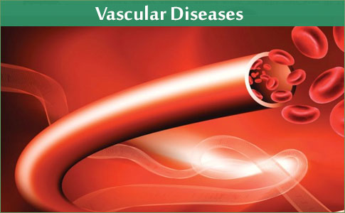 Vascular Diseases