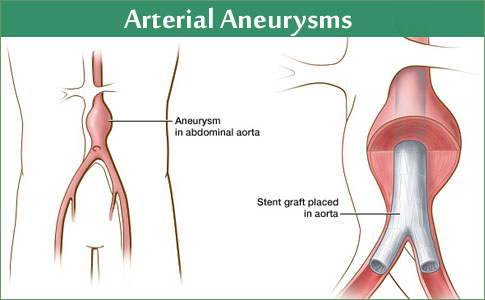 Arterial Aneurysms