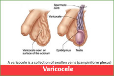 Varicocele