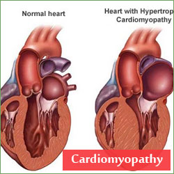 The Cardiomyopathies